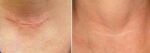 Giffarine Scar Gel 15 gr – Image 2